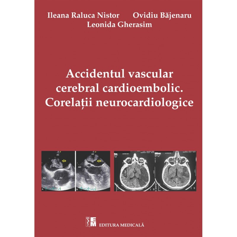Accidentul vascular cerebral cardioembolic | Ileana Raluca Nistor, Ovidiu Bajenaru, Leonida Gherasim